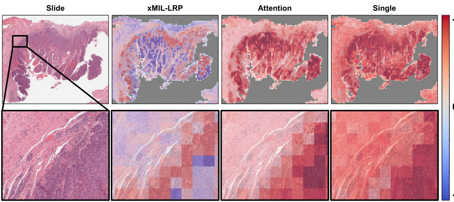 xMIL: Insightful Explanations for Multiple Instance Learning in ...